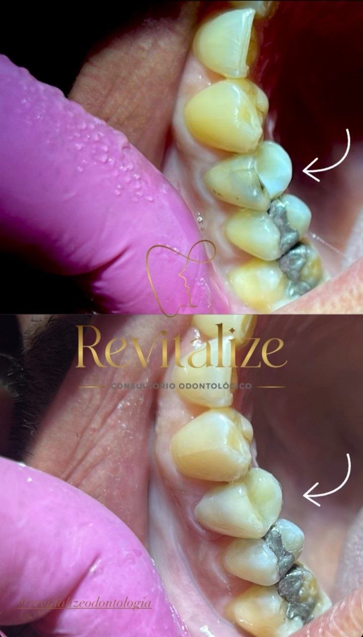 Antes e depois: restauração