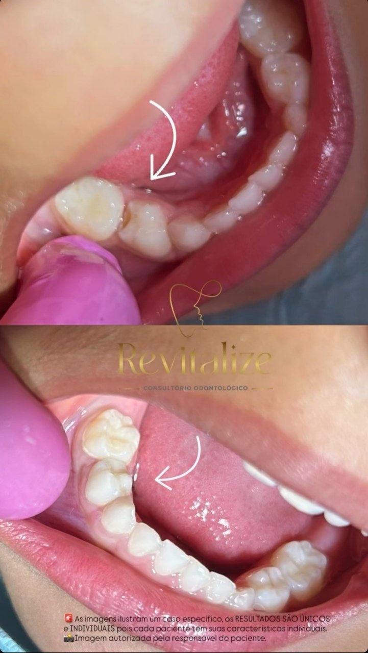 Antes e depois: restauração